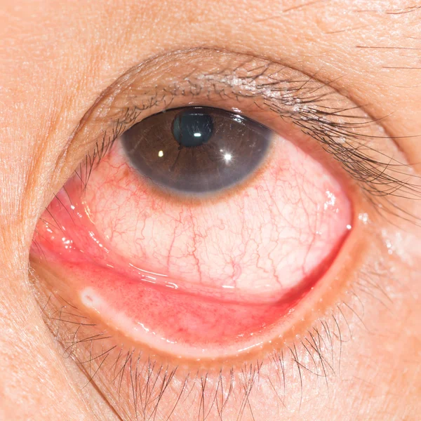 Conjunctivitis in oogtest — Stockfoto