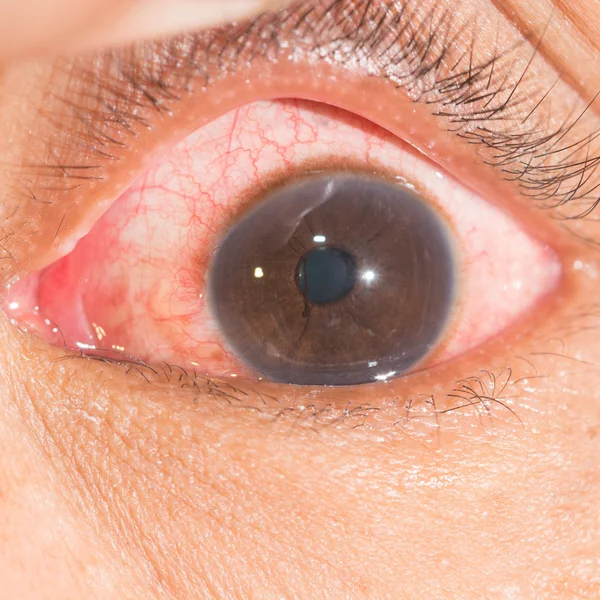 Conjunctivitis  at eye test — Stock Photo, Image