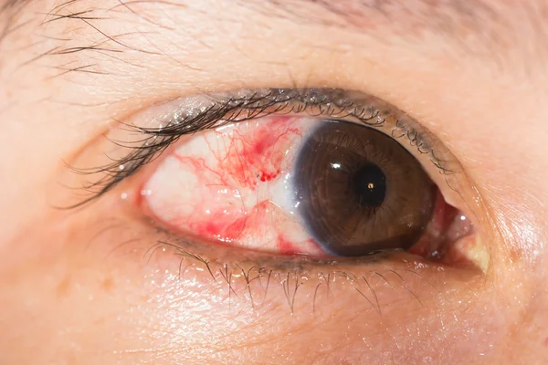 Pterygium excision at eye test — Stock Photo, Image