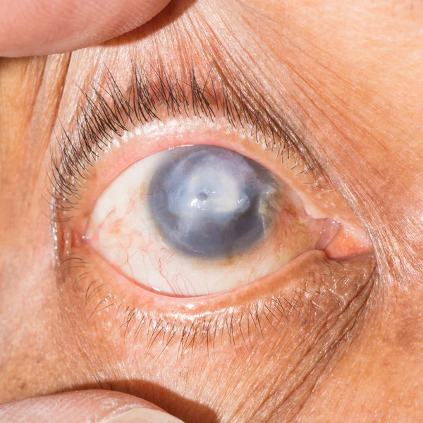 Cicatrice corneale al test dell'occhio — Foto Stock