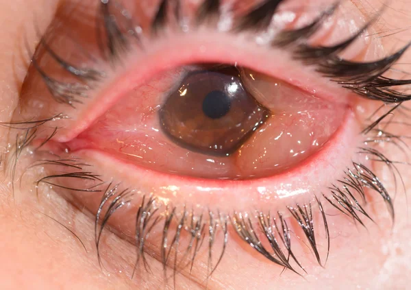 視力検査で結膜浮腫 — ストック写真