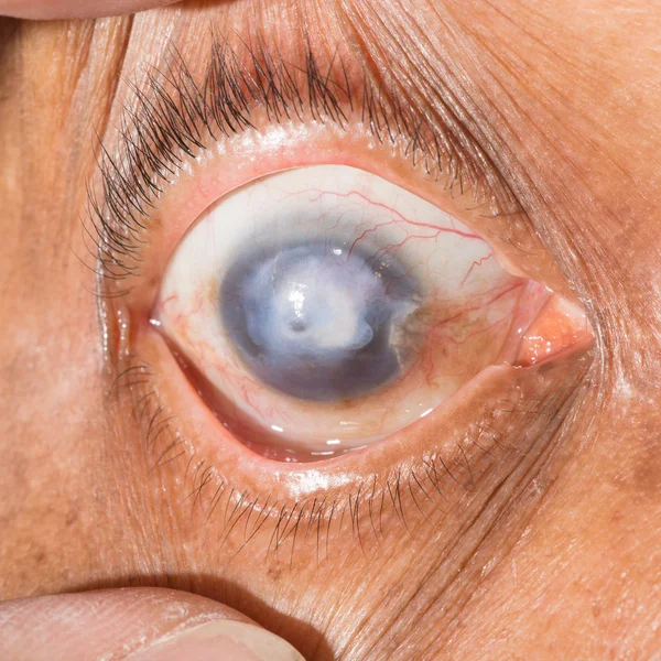 Corneal scar at eye test — Stock Photo, Image