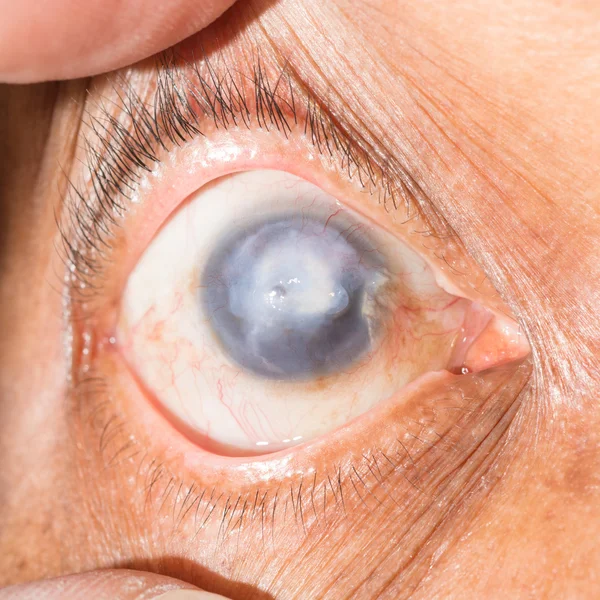 Cicatrice cornéenne au test oculaire — Photo