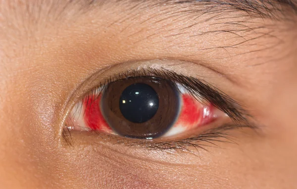 Hemorragia subconjuntival no exame oftalmológico — Fotografia de Stock