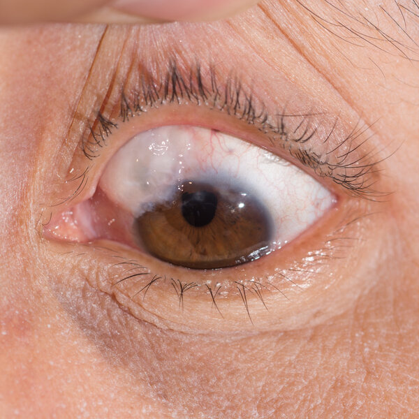 trabeculectomy bleb eye test