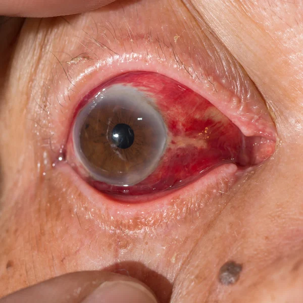 Subconjunctival hemorrhage at eye test — Stock Photo, Image