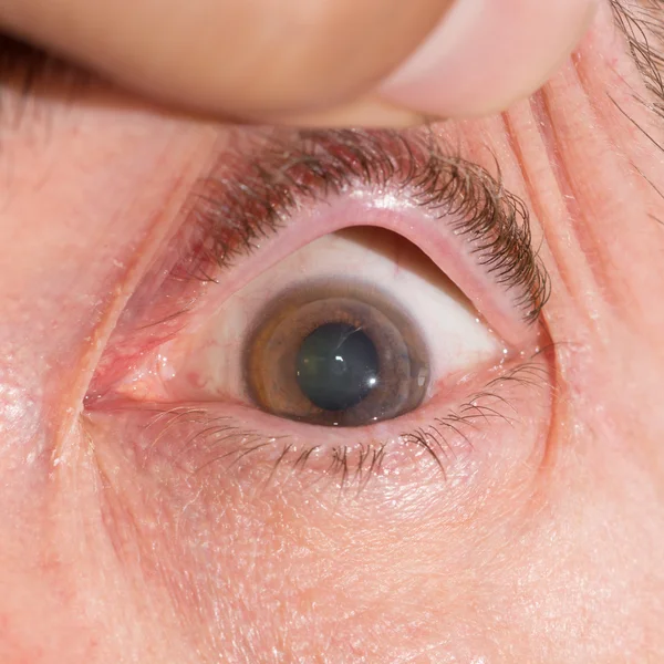 Cheratoplastica penetrante all'esame oculare — Foto Stock