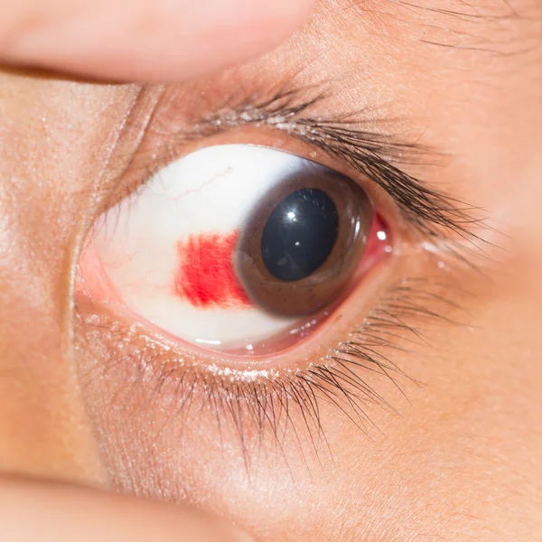 Subconjunctival bloeding op oogtest — Stockfoto