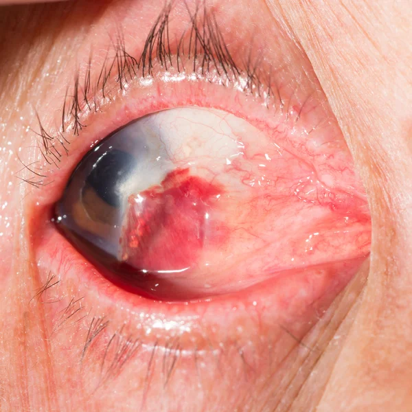 Subconjunctival krvácení v oční test — Stock fotografie