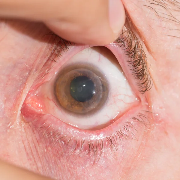 Cheratoplastica penetrante all'esame oculare — Foto Stock