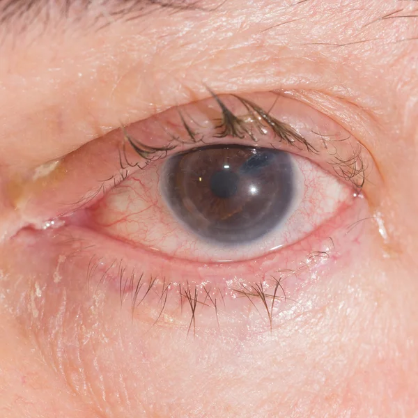 Indringende Keratoplasty op oogtest — Stockfoto