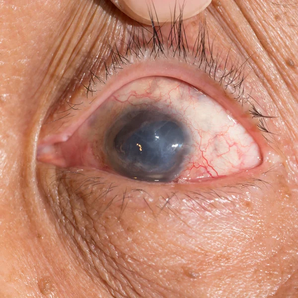 Phthisis bulbi σε εξέταση των ματιών — Φωτογραφία Αρχείου