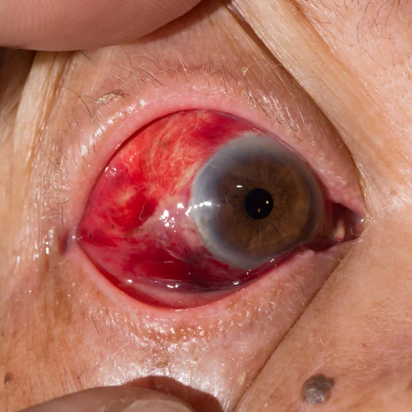 Субкон'юнктивна кровотеча при аналізі очей — стокове фото
