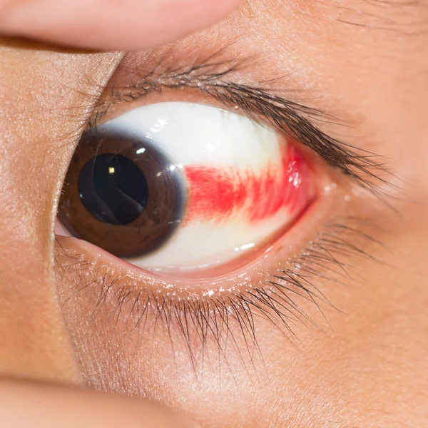 Subconjunctival krvácení v oční test — Stock fotografie