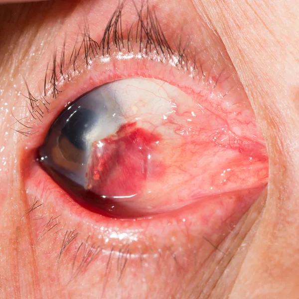 Subconjunctival hemorrhage at eye test — Stock Photo, Image