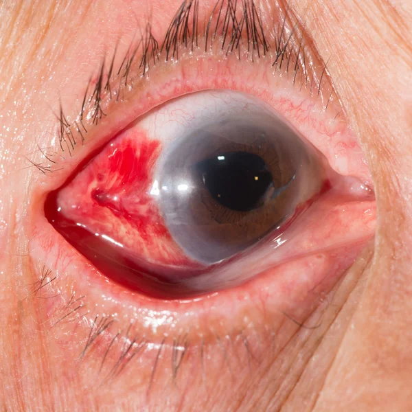 Subconjunctival hemorrhage at eye test — Stock Photo, Image