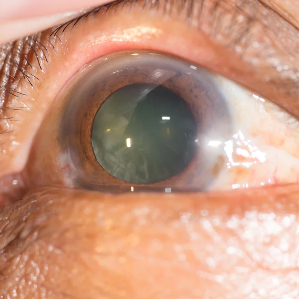 Catarata senil no teste oftalmológico — Fotografia de Stock