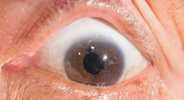 Senil no teste oftalmológico — Fotografia de Stock