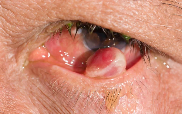 Pyogenic granuloma op oogtest — Stockfoto