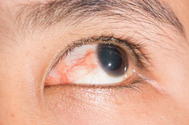 göz testi, Nodüler episcleritis