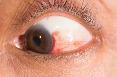 göz testi, subconjunctival kanama