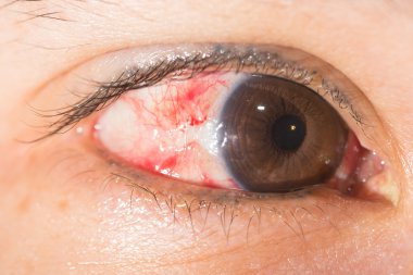 pterjium eksizyon göz testi