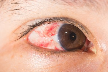 pterjium eksizyon göz testi