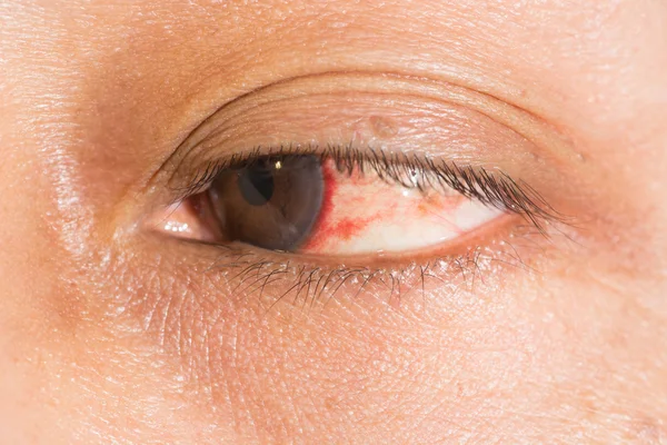 Subconjunctival bloeding op oogtest — Stockfoto