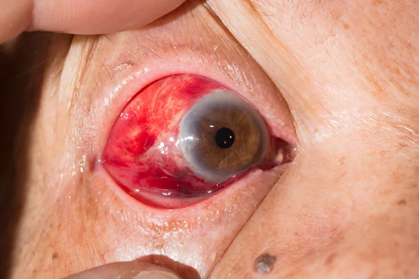 Subconjunctival hemorrhage at eye test — Stock Photo, Image