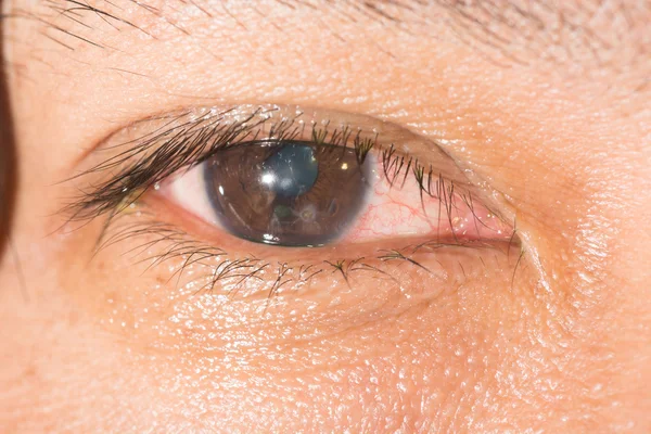 Anel de ferrugem da córnea no teste ocular — Fotografia de Stock