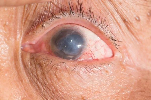 Phthisis bulbi at eye test — Stock Photo, Image