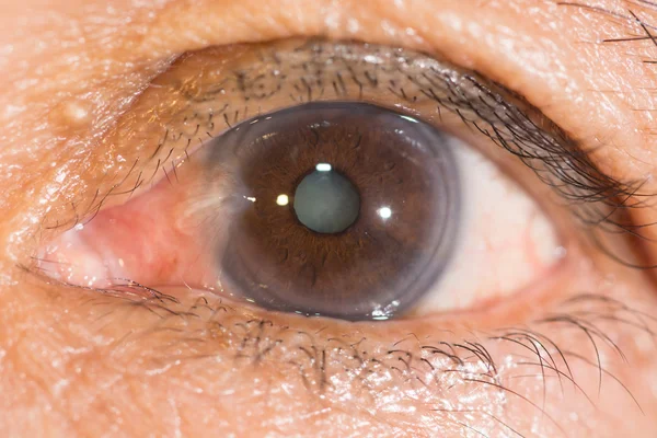Pterygium and senile cataract at eye test — Stock Photo, Image