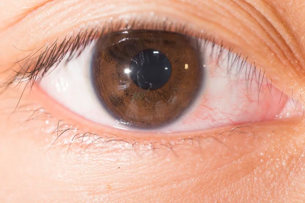 Nódulo da íris no teste ocular — Fotografia de Stock