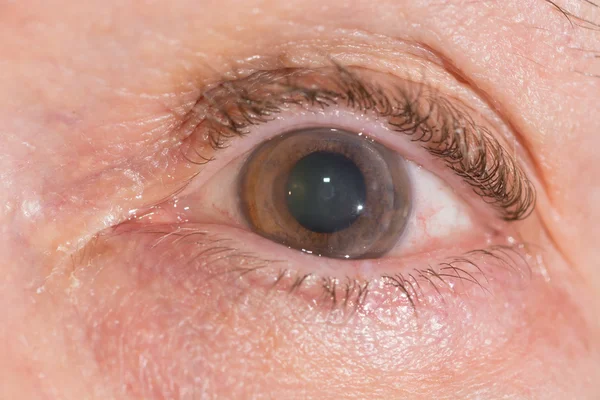 Queratoplastia penetrante en la prueba ocular — Foto de Stock