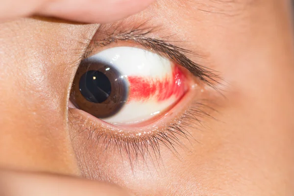 Hemorragia subconjuntival no exame oftalmológico — Fotografia de Stock