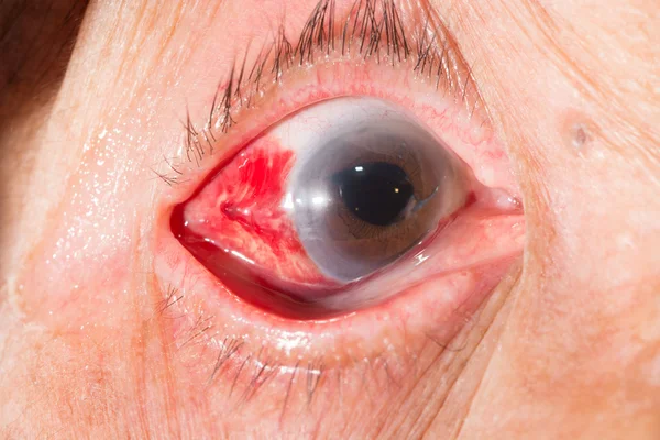 Subconjunctival hemorrhage at eye test — Stock Photo, Image