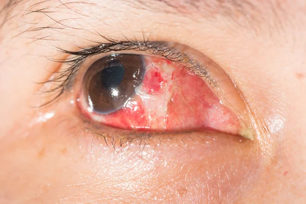 Escisión de pterigión en la prueba ocular — Foto de Stock