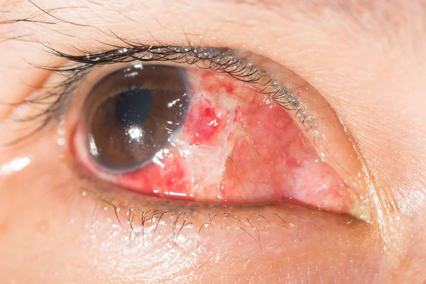 Excisão do pterígio no teste oftalmológico — Fotografia de Stock