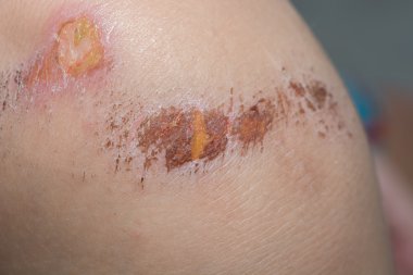 skin wound