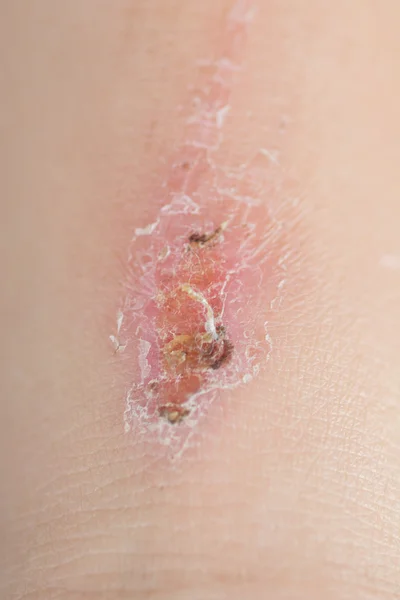 Skin wound — Stock Photo, Image
