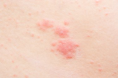 veziküler döküntü