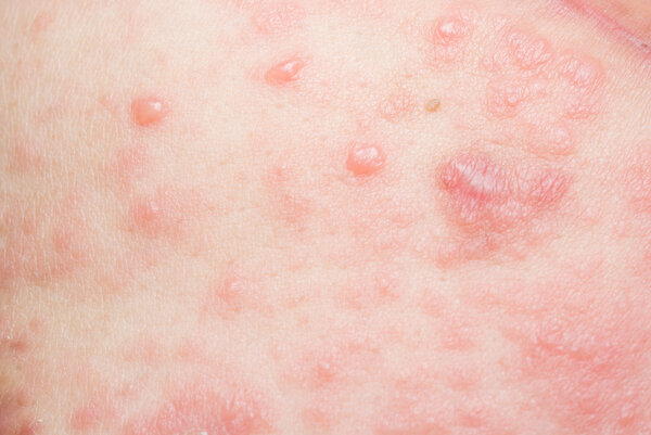 vesicular rash