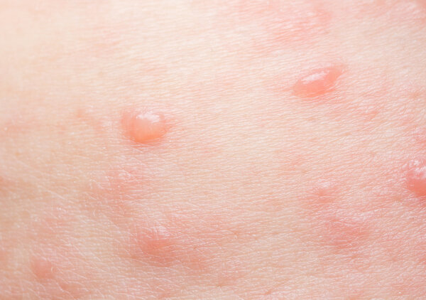 vesicular rash