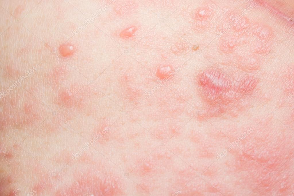 Pikkelysömör vagy seborrhoeás dermatitisz? Hasonló, de nem ugyanaz