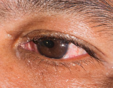 göz muayenesinde, kopma Küre