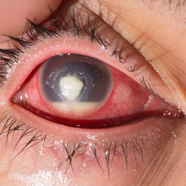 1 Corneal Ulcer Stock Photos Images Download Corneal Ulcer Pictures On Depositphotos 1 Corneal Ulcer Stock Photos Images Download Corneal Ulcer Pictures On Depositphotos
