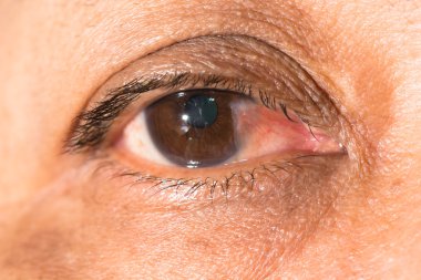 eye examination, advance pterygium clipart