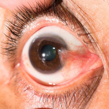 göz muayenesinde, önceden pterjium
