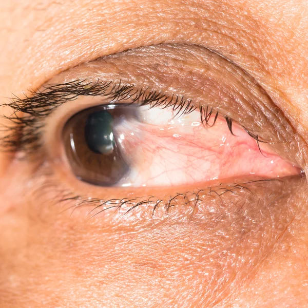 Oog onderzoek, voorschot pterygium — Stockfoto