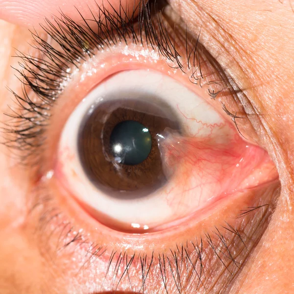 Ögonundersökning, advance pterygium — Stockfoto